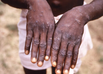 MPOX